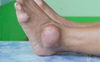 Gout - Symptoms and causes